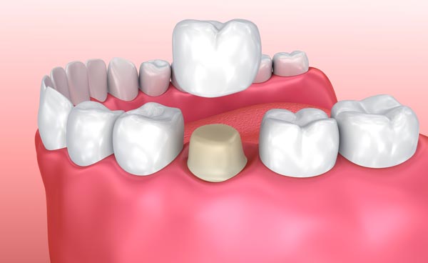 dentalcrown